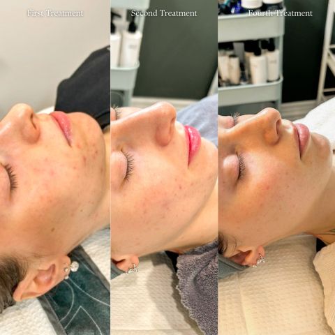 Chemical Peel for Acne